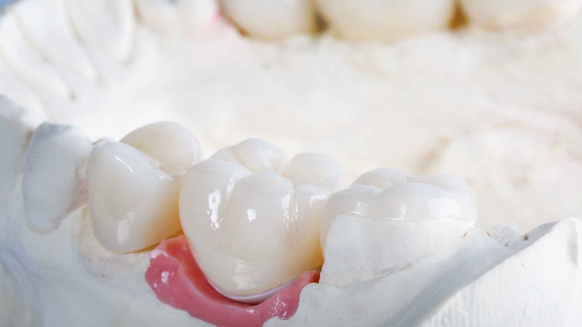 מדוע כתרי זירקוניה הם הבחירה האולטימטיבית לשיקום שיניים?