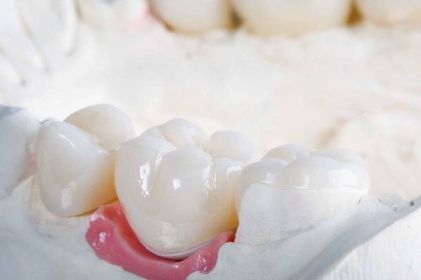 כתר זירקוניה לשיניים2