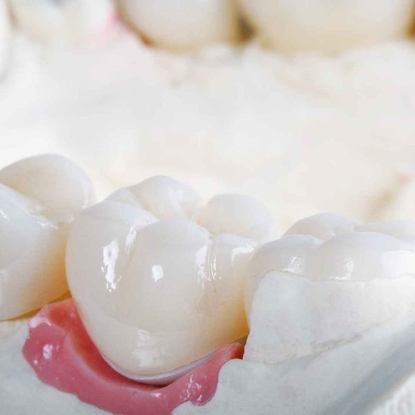 כתר זירקוניה לשיניים2